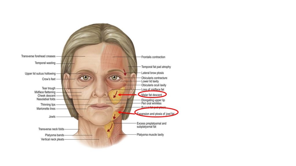 糸リフトをするときに重要となる脂肪の解剖。メーラーファット、ジョールファットを図示しています。東京上野｜フィレールクリニック｜美容整形